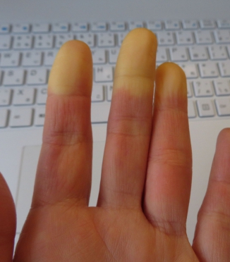 Raynauds syndrom och sömn — varför händer och fötter fryser på natten och hur man bekämpar det