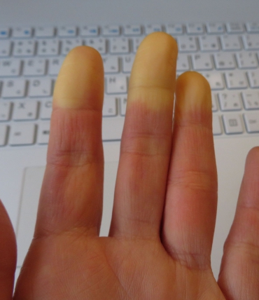 Raynauds syndrom och sömn — varför händer och fötter fryser på natten och hur man bekämpar det